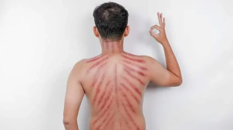 Ketahui Fakta di Balik Kerokan saat Masuk Angin