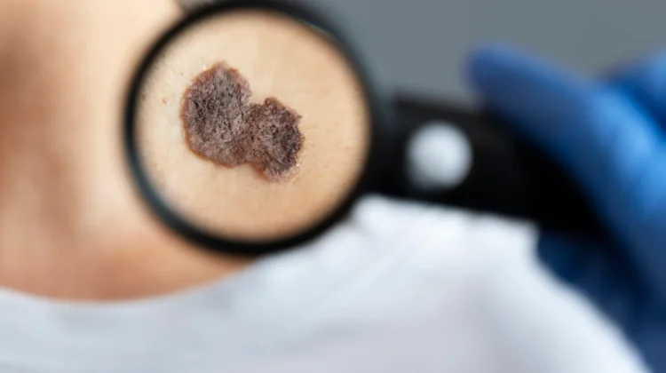 Kenali Melanoma pada Anak, Kanker Kulit Langka yang Perlu Diwaspadai