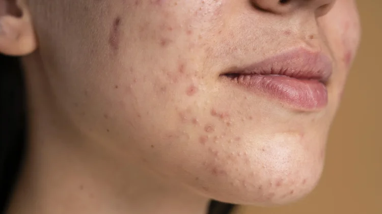 Remaja Mulai Pakai Skincare? Hindari Kesalahan Ini