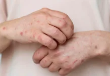 Kewaspadaan Campak Meningkat, Kota Bogor Perkuat Imunisasi dan Deteksi Dini