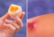 Mitos atau Fakta: Makan Telur Bisa Bikin Bisulan?