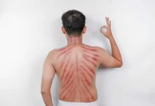Ketahui Fakta di Balik Kerokan saat Masuk Angin