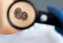 Kenali Melanoma pada Anak, Kanker Kulit Langka yang Perlu Diwaspadai