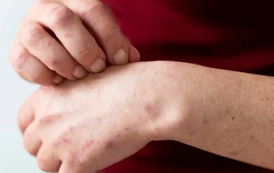 Kasus Suspek Campak di Kota Bogor Meningkat, Dinkes Siapkan Imunisasi Kejar MR