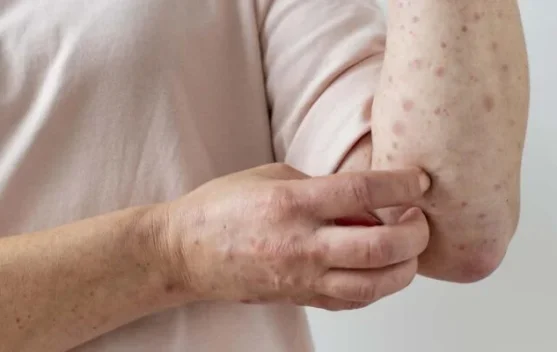 Kasus Campak Meningkat, Dosen IPB University Ingatkan Pentingnya Kekebalan Popul