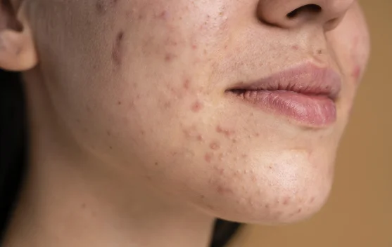 Cara Menghilangkan Bekas Jerawat Sesuai Jenisnya, Jangan Asal Pilih Skincare