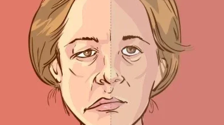 Mengenal Penyakit Bell’s Palsy, Gangguan Saraf pada Wajah