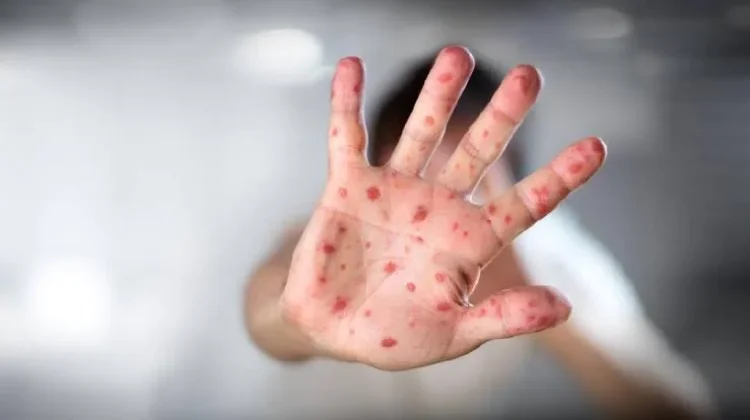 Imunisasi Dasar di Kabupaten Bone Capai 85 Persen