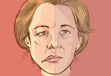 Mengenal Penyakit Bell’s Palsy, Gangguan Saraf pada Wajah