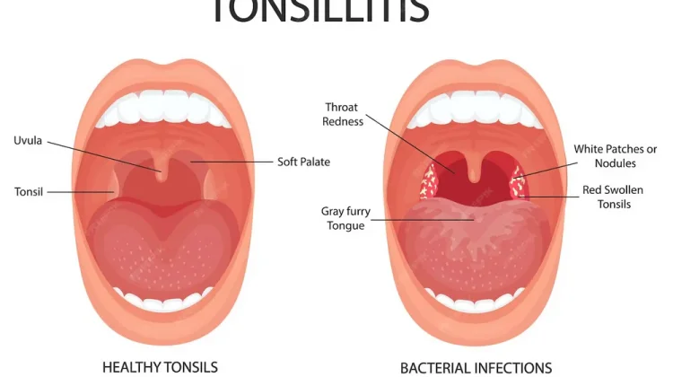 Jarang Diketahui! Inilah Fakta tentang Amandel di Tubuh Kita