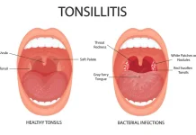 Jarang Diketahui! Inilah Fakta tentang Amandel di Tubuh Kita