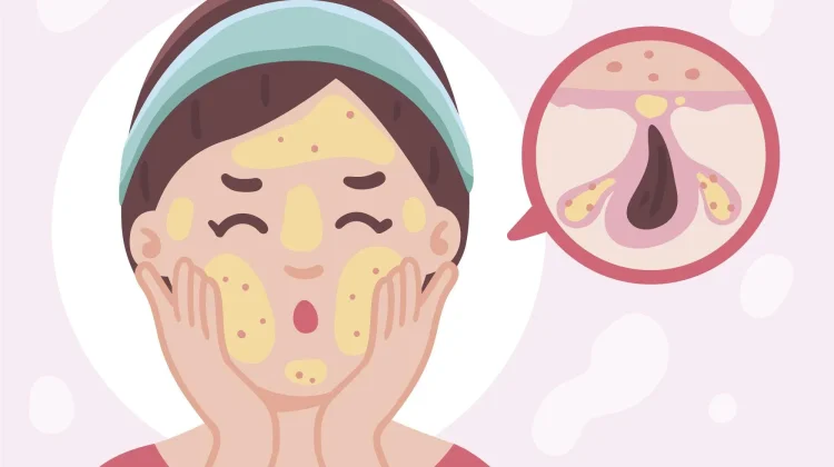 Menjaga Wajah Tetap Segar meski Memiliki Oily skin