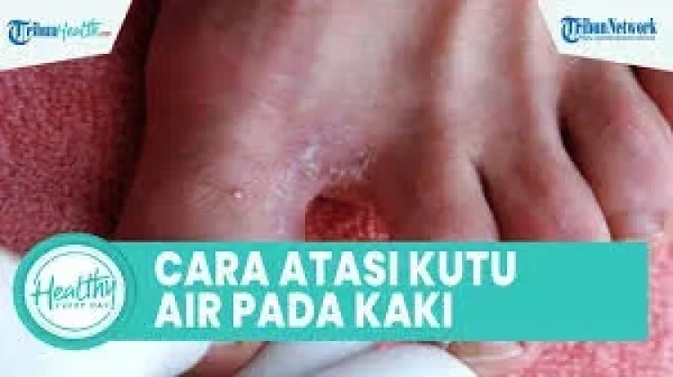 Penyebab, dan Gejala Kutu Air