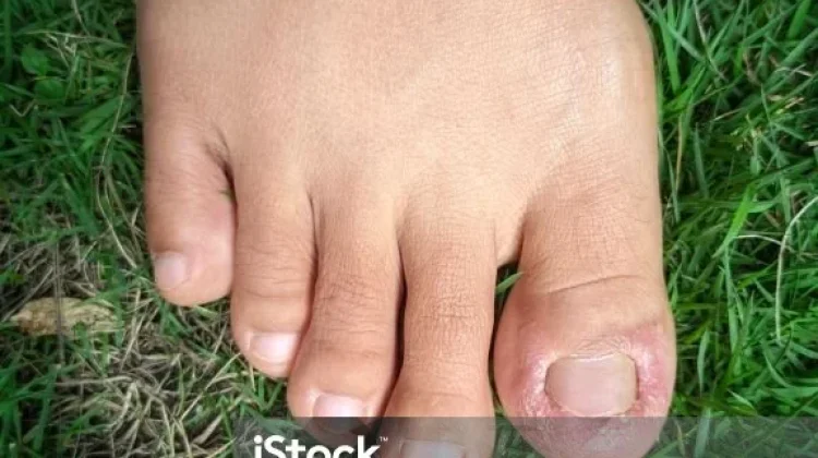 Beragam Penyebab Jempol Kaki Kebas