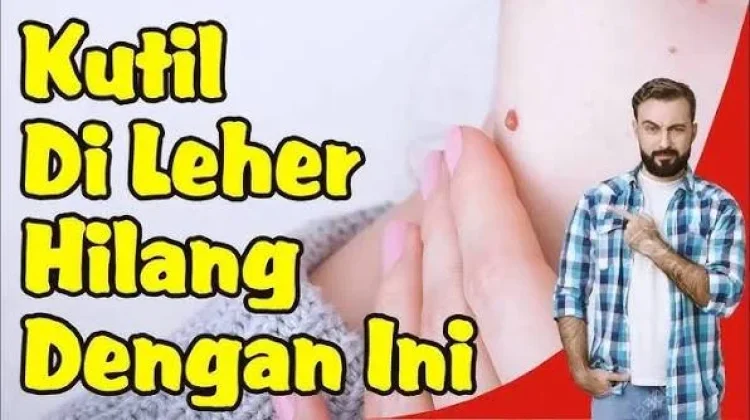 Cara Menangani Kutil pada Kulit