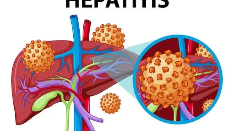 Virus Hepatitis Mengendap Diam, Deteksi Dini Jadi Penyelamat