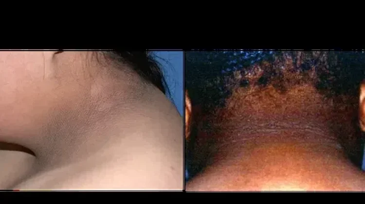 Tanda-tanda Diabetes yang Bisa Terlihat pada Kaki