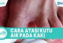 Penyebab, dan Gejala Kutu Air
