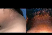 Tanda-tanda Diabetes yang Bisa Terlihat pada Kaki