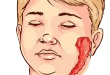 Penyakit Menular yang Sering Menyerang Anak