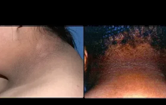 Tanda-tanda Diabetes yang Bisa Terlihat pada Kaki