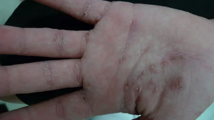 Cara Menangani Anak Scabies di Rumah Dari Pesantren