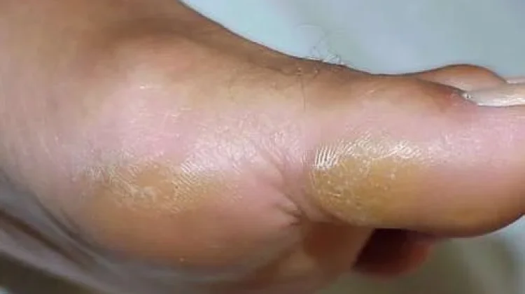Cara Efektif Hilangkan Kapalan di kaki Ala Rumahan