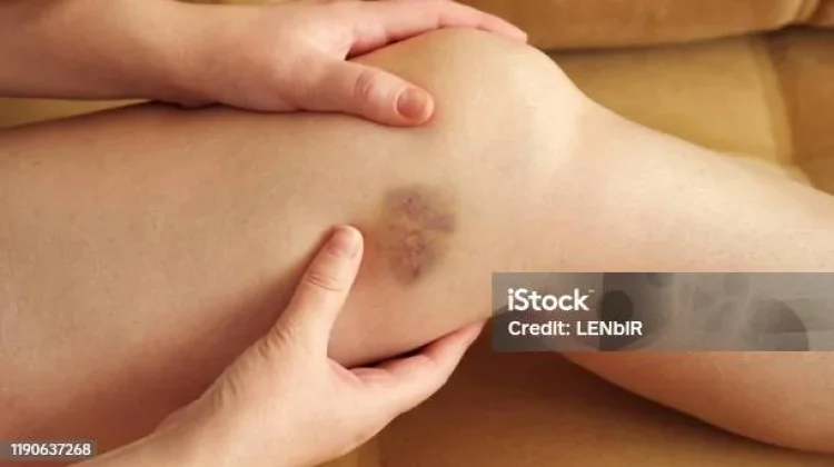 Sering Memar Tanpa Sebab? Kenali Pemicu Kaki Mudah Lebam