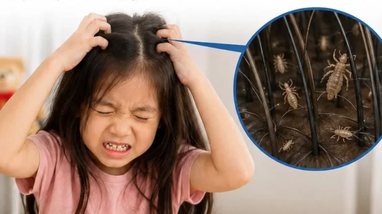 Benarkah Kutu Kecil Lebih Gatal daripada Kutu Besar?