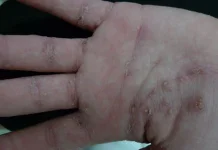 Cara Menangani Anak Scabies di Rumah Dari Pesantren