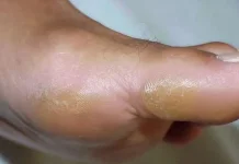 Cara Efektif Hilangkan Kapalan di kaki Ala Rumahan