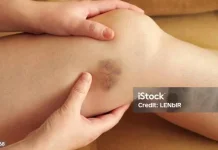 Sering Memar Tanpa Sebab? Kenali Pemicu Kaki Mudah Lebam