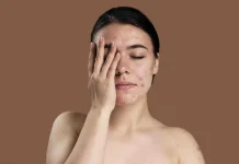 Penyakit Kulit Pengaruhi Kesehatan Psikologis dan Biologis