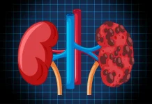 Kurang Minum pada Cuaca Panas Dapat Memicu Gagal Ginjal