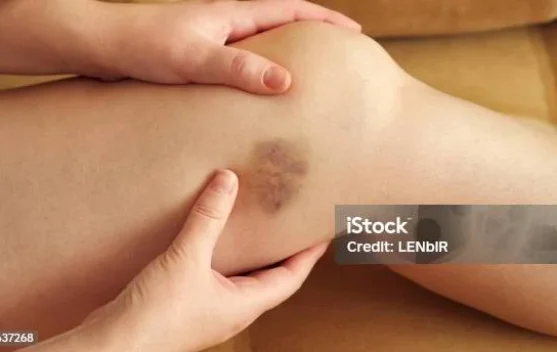 Sering Memar Tanpa Sebab? Kenali Pemicu Kaki Mudah Lebam