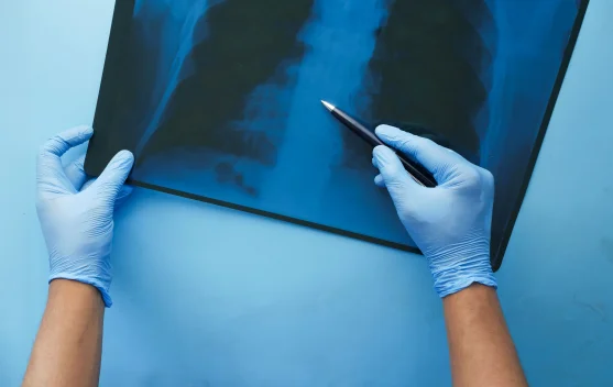 Deteksi Dini TB Diperkuat untuk Dukung Target Eliminasi Tuberkulosis