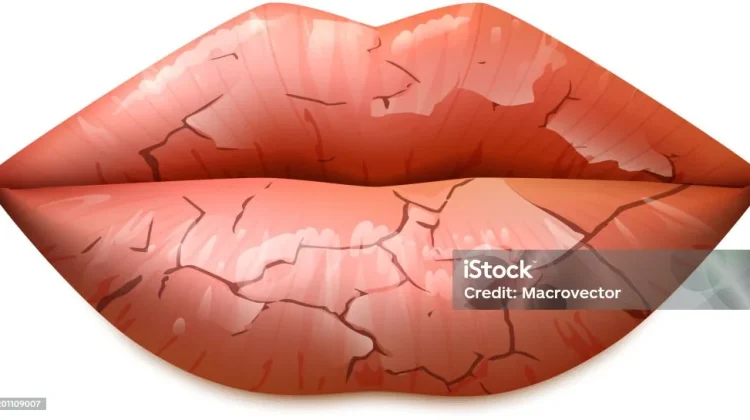 Penyebab Bibir Kering dan Cara Mengatasinya