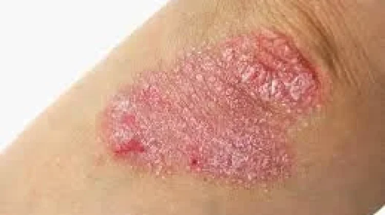Cara Mengatasi Psoriasis: Dimulai dari Usus bukan Kulit
