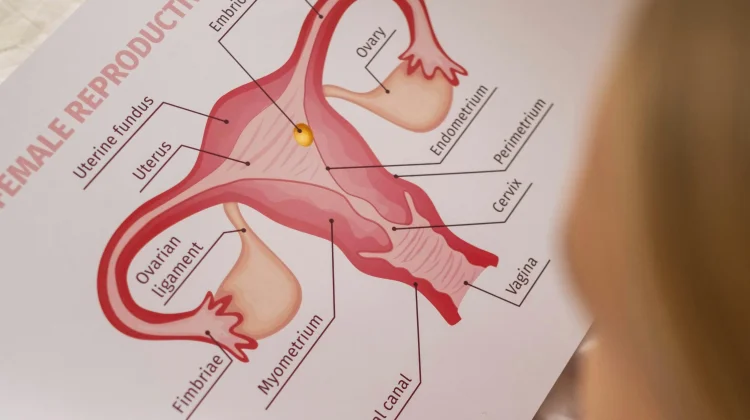 Bukan Lagi PCOS, Kenali Istilah Baru PMOS