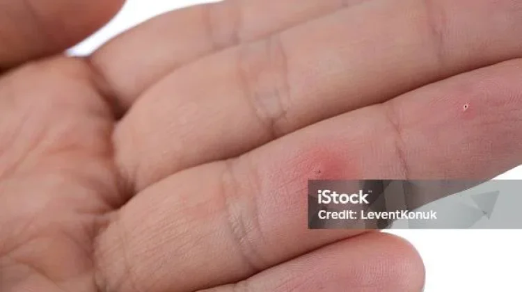 Tertancap Benda Asing di Kulit, Ini Penyebab Susuban dan Cara Menanganinya
