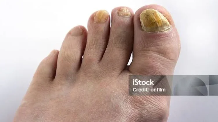 Kuku Kaki Menguning, Apa Penyebabnya?