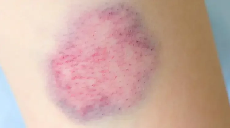 Hati-Hati Memar Pasca Benturan, Pakar Peringatkan Para Atlet Bahaya Hematoma