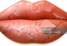 Penyebab Bibir Kering dan Cara Mengatasinya