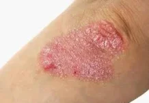 Cara Mengatasi Psoriasis: Dimulai dari Usus bukan Kulit
