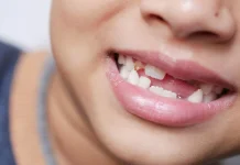 Pentingnya Cabut Gigi Susu Sesuai pada Waktunya