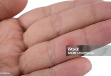 Tertancap Benda Asing di Kulit, Ini Penyebab Susuban dan Cara Menanganinya