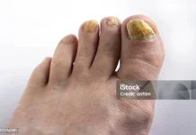 Kuku Kaki Menguning, Apa Penyebabnya?