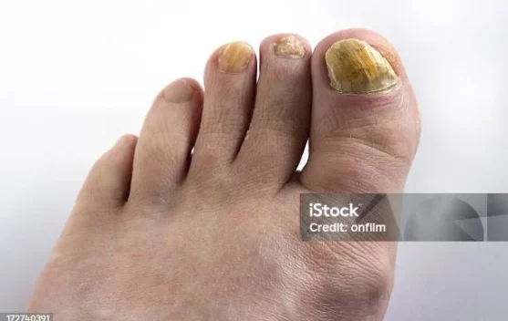 Kuku Kaki Menguning, Apa Penyebabnya?