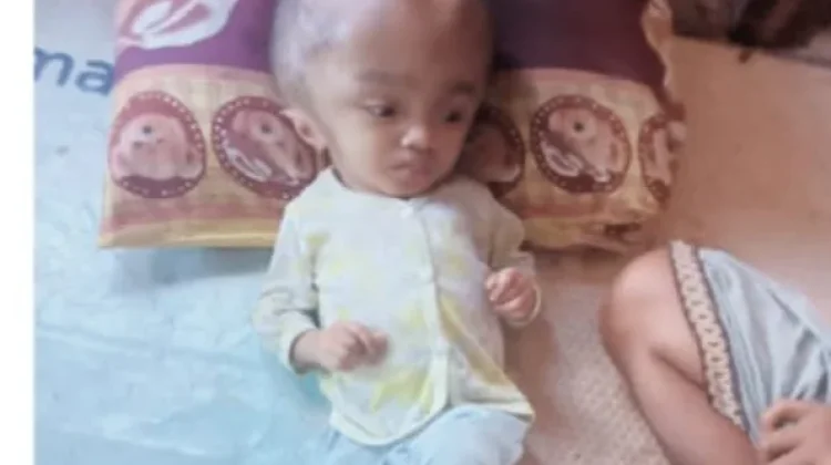 Maria, Anak Penderita Hidrosefalus di Manggarai Timur Butuh Biaya Pengobatan