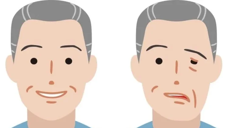 Kenali Gejala Stroke dengan SEGERA KE RS, Jangan Tunggu Sampai Terlambat